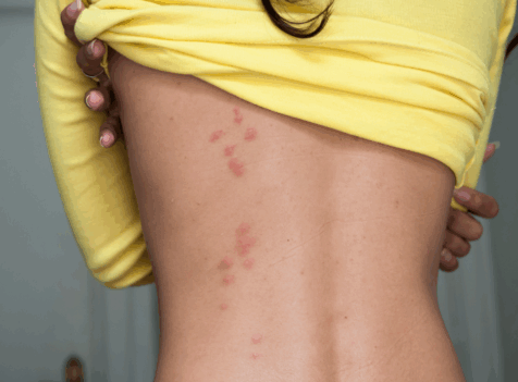 Bedbug Control in Barking – Professional Treatments and Removal