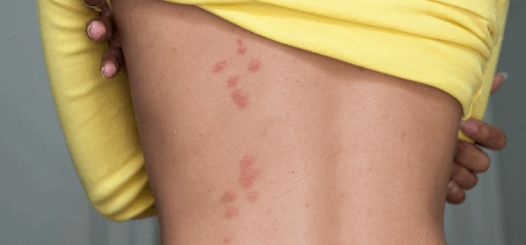 Bedbug Control in Barking – Professional Treatments and Removal